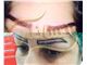 کاشت ابرو با تکنیک های SUT و FUE
