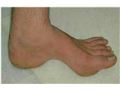 بیماریهای ناحیه کف پا مانند صافی  کف پا ، بونیون،قوس زیاد کف پا،خار پاشنه و کفش و کفی مناسب آنها