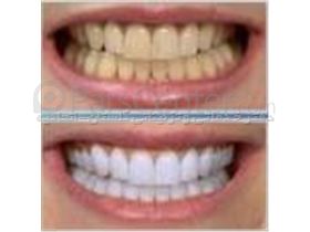لاک سفید کننده دندان   لاک سفید کننده دندان