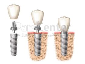 آشنایی با اجزای ایمپلنت دندان و کاربرد های آن ها