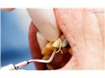 نخ زیر لثه‌ای چیست و در درمانهای دندانپزشکی چه کاربردی دارد؟