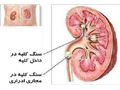 علل ایجاد سنگ کلیه   و درمان ان