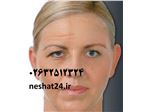 تزریق بوتاکس و رفع چین و چروک ( صورت ، پیشانی و اطراف چشم)
