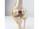 مولاژ مفصل زانو