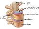 درمان بیرون زدگی دیسک