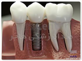 شرایط کاشت ایمپلنت دندان به چه صورت است و چه افرادی می توانند این کار را انجام دهند