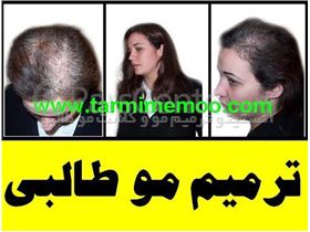درمان ریزش موی سر در زنان و خانم ها = ترمیم موی طبیعی و کاشت موی طبیعی طالبی