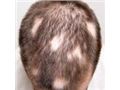 ریزش موی سکه ای  Alopecia areata  